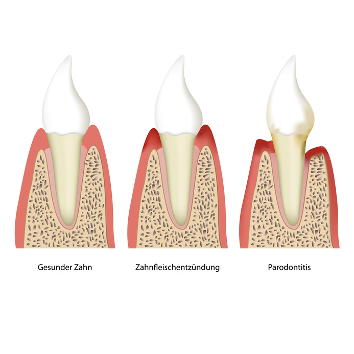 Zahnfleischentzündung und Parodontose