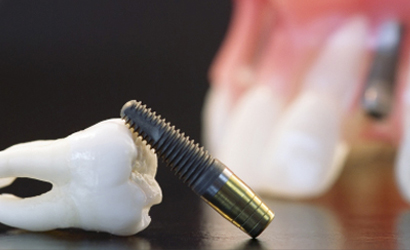 Zahnarzt Grossenhain Implantate